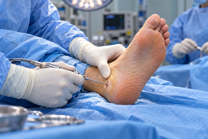 intervento chirurgico per la spina calcaneare
